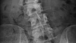 My lumbar spine scolosis